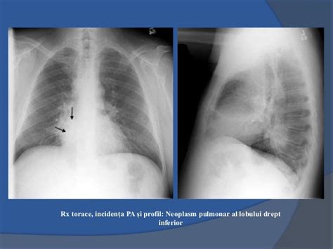 Profil neoplasm pulmonar